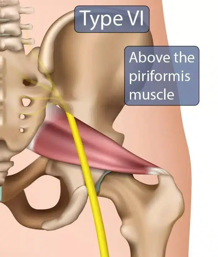 sciatic-nerve-treatment-6 at Vital Mill Creek Chiropractic